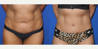 Case 257 - Woman treated with Tummy Tuck