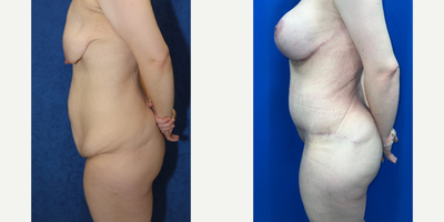 Case 2574 - 25-34 year old woman treated with Tummy Tuck