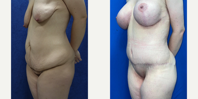 Case 2575 - 25-34 year old woman treated with Tummy Tuck