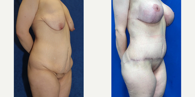 Case 2576 - 25-34 year old woman treated with Tummy Tuck