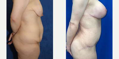 Case 2577 - 25-34 year old woman treated with Tummy Tuck