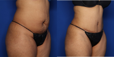 Case 2578 - 35-44 year old woman treated with Tummy Tuck