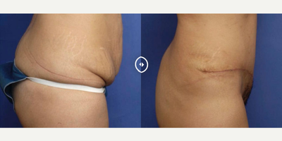 Case 2579 - Woman treated with Tummy Tuck