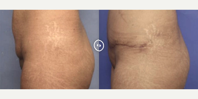 Case 2580 - Woman treated with Tummy Tuck