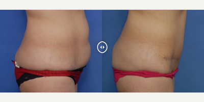 Case 2581 - Woman treated with Tummy Tuck