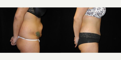 Case 2583 - Woman treated with Tummy Tuck