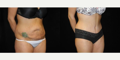 Case 2584 - Woman treated with Tummy Tuck