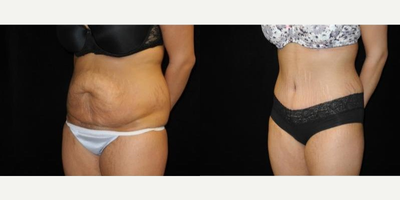 Case 2585 - Woman treated with Tummy Tuck