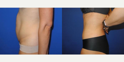 Case 2586 - 40 year old woman treated with Tummy Tuck