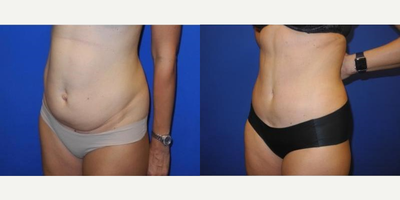 Case 2587 - 40 year old woman treated with Tummy Tuck