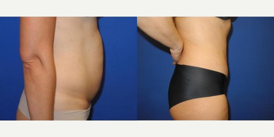 Case 2588 - 40 year old woman treated with Tummy Tuck