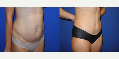 Case 2589 - 40 year old woman treated with Tummy Tuck