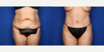 Case 259 - 35-44 year old woman treated with Tummy Tuck