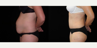 Case 2590 - Woman treated with Tummy Tuck