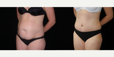 Case 2591 - Woman treated with Tummy Tuck
