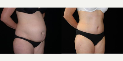 Case 2592 - Woman treated with Tummy Tuck