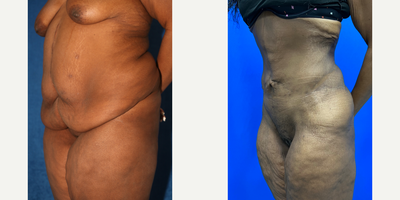 Case 2593 - 35-44 year old woman treated with Tummy Tuck