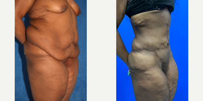 Case 2594 - 35-44 year old woman treated with Tummy Tuck