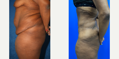 Case 2595 - 35-44 year old woman treated with Tummy Tuck