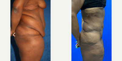 Case 2596 - 35-44 year old woman treated with Tummy Tuck