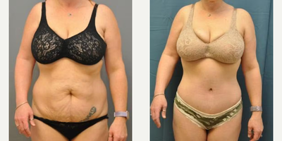 Case 26 - Woman treated with Tummy Tuck