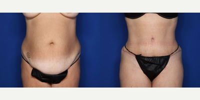 Case 260 - 45-54 year old woman treated with Tummy Tuck