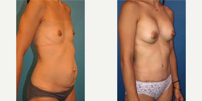 Case 2607 - Woman treated with Tummy Tuck