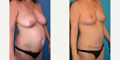 Case 2608 - Woman treated with Tummy Tuck