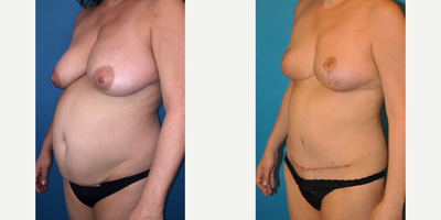 Case 2609 - Woman treated with Tummy Tuck