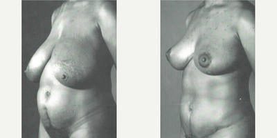 Case 2610 - Woman treated with Tummy Tuck