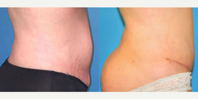 Case 2611 - Woman treated with Tummy Tuck