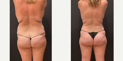 Case 2616 - 35-44 year old woman treated with Mommy Makeover, Breast Lift, Tummy Tuck