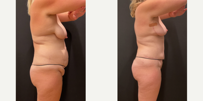 Case 2617 - 35-44 year old woman treated with Mommy Makeover, Breast Lift, Tummy Tuck