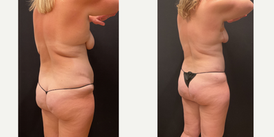 Case 2618 - 35-44 year old woman treated with Mommy Makeover, Breast Lift, Tummy Tuck
