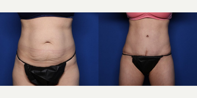 Case 262 - 35-44 year old woman treated with Tummy Tuck