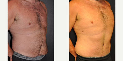 Case 2620 - 36 year old woman treated with Liposuction, Tummy Tuck