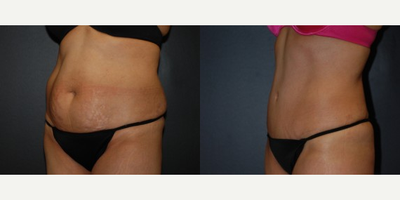 Case 2621 - Woman treated with Tummy Tuck