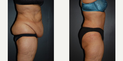 Case 2622 - Woman treated with Tummy Tuck