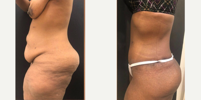 Case 2629 - 35-44 year old woman treated with Tummy Tuck