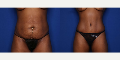 Case 263 - 25-34 year old woman treated with Tummy Tuck