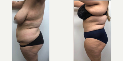 Case 2630 - 25-34 year old woman treated with Tummy Tuck