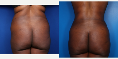 Case 2637 - 45-54 year old woman treated with Tummy Tuck