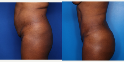 Case 2638 - 45-54 year old woman treated with Tummy Tuck