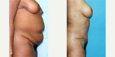 Case 2639 - Woman treated with Tummy Tuck
