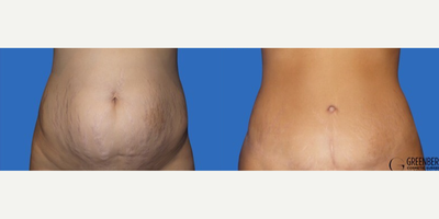 Case 264 - Woman treated with Tummy Tuck