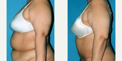 Case 2640 - Woman treated with Tummy Tuck