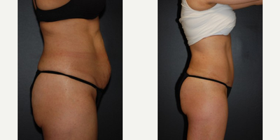 Case 2641 - Woman treated with Tummy Tuck