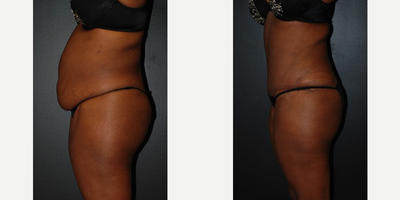 Case 2642 - Woman treated with Tummy Tuck