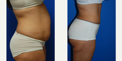 Case 2643 - Woman treated with Tummy Tuck