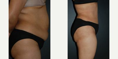 Case 2644 - Woman treated with Tummy Tuck